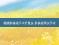 眼睛斜视做手术后复发 斜视做两次手术